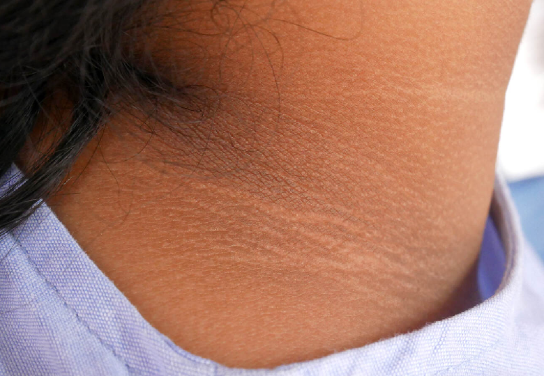 Acanthosis nigricans: what is it, symptoms, causes and treatment?