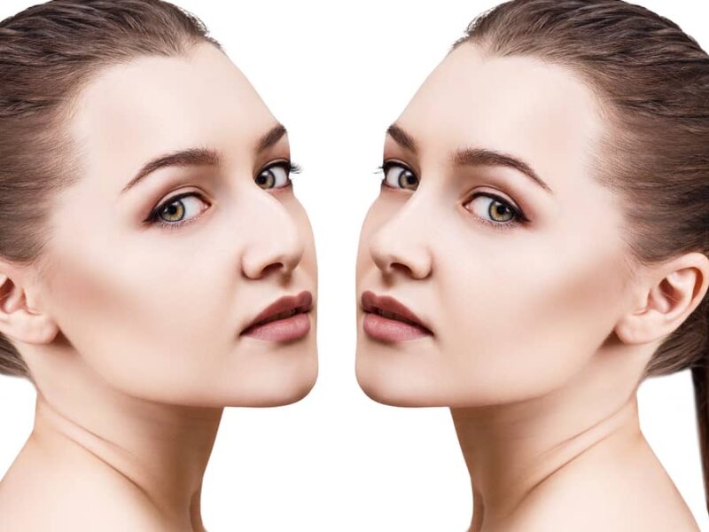 How Do You Get The Best Type Of Rhinoplasty For Women?